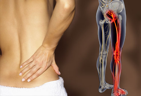 Sciatica, Lower Back Pain, Chiropractor Bangor