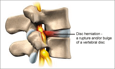Spine Bones, Disc Problems, Chiropractor Belfast