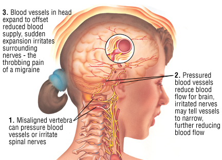 Migraine, Blood Vessels in head, Cloverfield Chiropractic